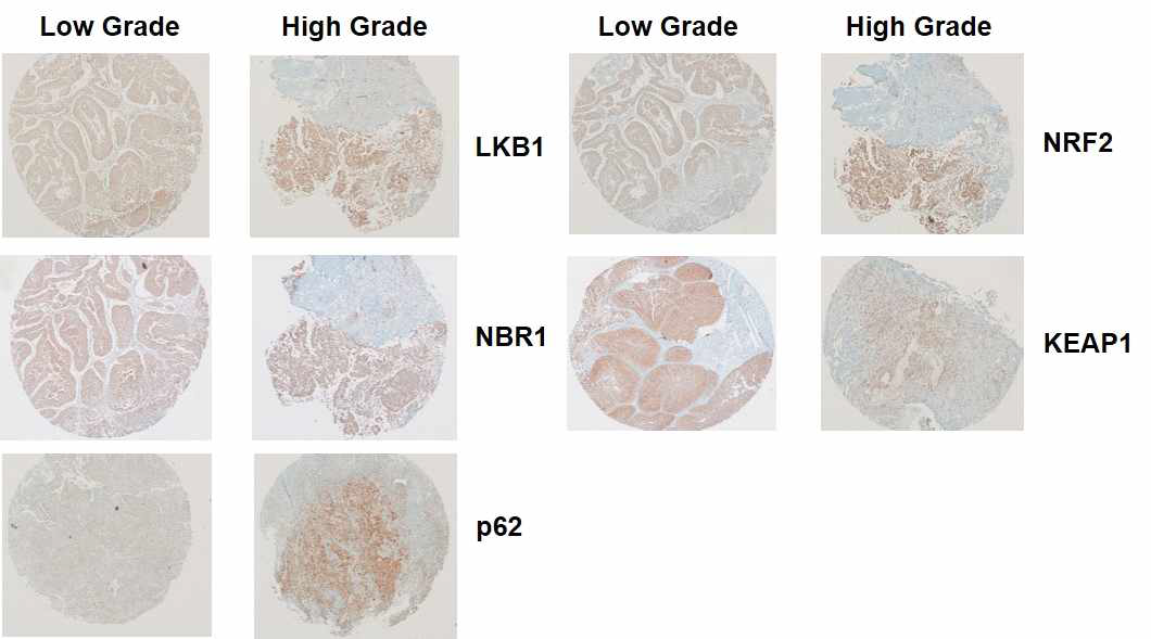 Tissue microarray (TMA) in high grade and low grade tissues of bladder cancer patients