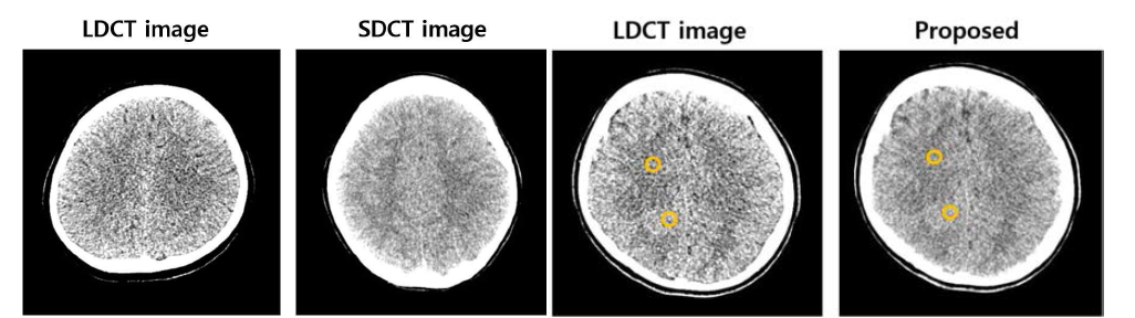 LDCT영상 (세번째) 및 보정 영상 (네번째). 첫 번째, 두 번째 그림은 각각 훈련에 사용된 LDCT, SDCT영상을 나타냄