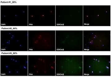 Changes of the serine inhibitory phosphorylation of GSK-3 (p-GSK-3α/β) in various motility human sperm
