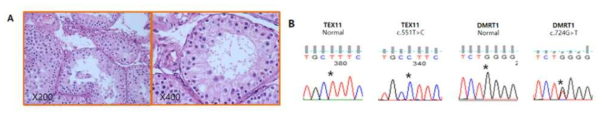 Testicular biopsy result of patient with TEX11 variant (A) and chromosome chromatograms for TEX11 and DMRT1 (B)