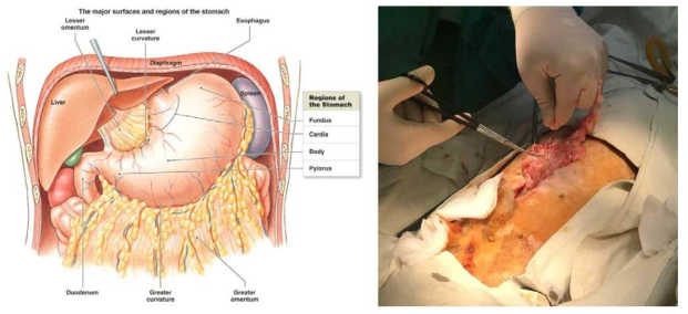 좌) 대장간막의 해부학적 위치 모식도 우) 실제 수술에서 제거한 대장간막의 모습
