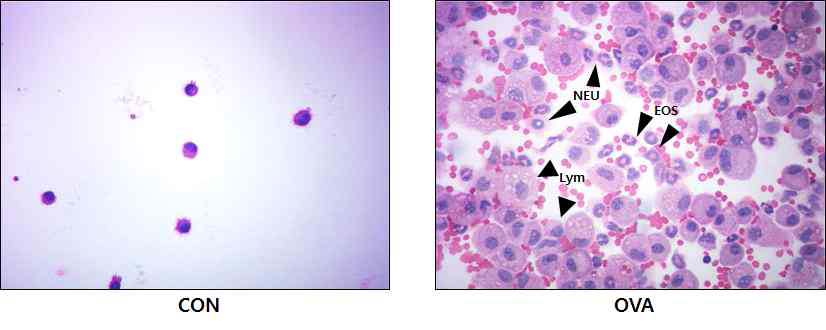 기관지폐포세척액 내 각각의 염증세포 (현미경 x 400)