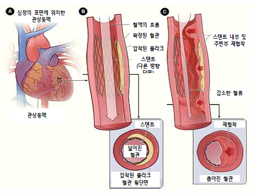 스텐트 내 재협착 (ISR, In-stent restenosis)