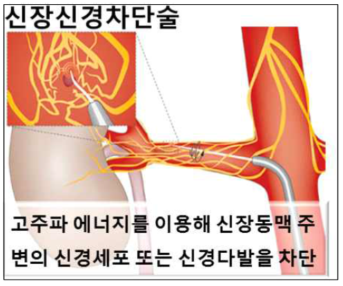 신장신경차단술 (Eur. Heart J. 2011; 32, 537-544)