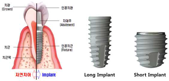 국내개발 치과용 임플란트시스템, long implant와 short implant의 모식도