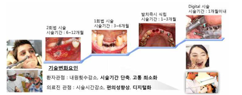 치과용 임플란트 시술 및 요구사항