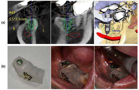 Computer aided surgery (a) 3D digital implant planning with software, (b) surgical template