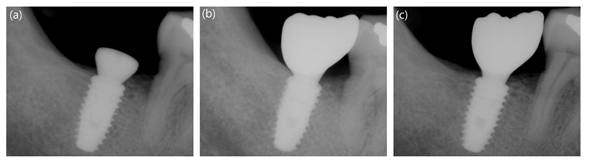 Standard periapical radiographs of implants placed in a patient in the control group (CMI IS-III active® long implant, Neobiotech Co., Seoul, Korea): (a) at surgery, (b) at 12 weeks, and (c) at 48 weeks