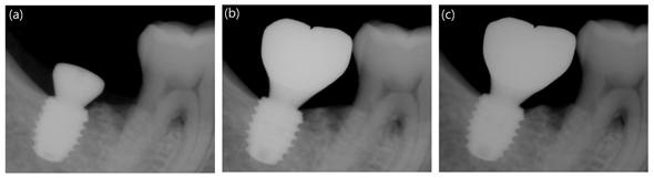 Standard periapical radiographs of implants placed in a patient in the experimental group (CMI IS-III active® short implant, Neobiotech Co., Seoul, Korea): (a) at surgery, (b) at 12 weeks, and (c) at 48 weeks