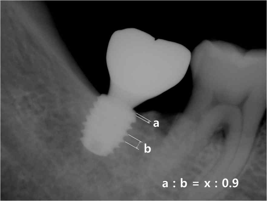 Measurement of marginal bone loss (MBL) on periapical radiograph(x : distance between platform and periimplant bone crest