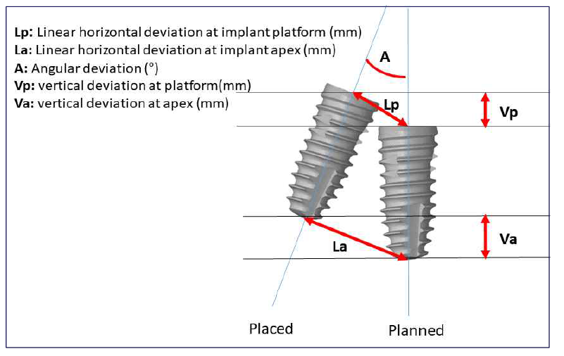 5 parameters showing deviation between placed and planned implant