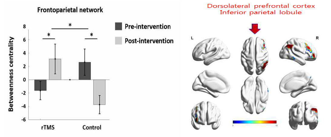 BC values of the identified brain network that showed significant differences between preand post-rTMS intervention and interaction effect. Error bars represent ±1 standard error of the mean