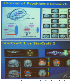 인터넷 게임 중독환자의 뇌와 프로게이머의 뇌 비교