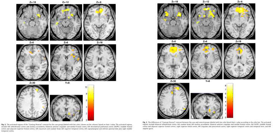 약물 중독 환자의 뇌 활성화(오른쪽)과 인터넷 게임 중독 환자의 뇌 활성화(왼쪽) (Ko et al., 2009)