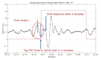 Dual window algorithm 척수 자극 후 근육 반응 (1회)