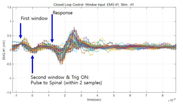 Dual window algorithm 척수 자극 후 근육 반응 모음