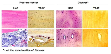 전립선암 환자 중 골전이가 된 부분의 뼈를 수집하여 탈회한 후 H&E 염색 및 TRAP 염색을 시행함. 해부실습용 시신에서 환자뼈와 같은 위치의 뼈를 얻어 대조군으로 사용함