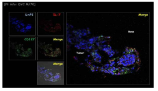 전이성 골암조직에서 IL-7과 IL-7Ra의 발현이 모두 관찰. 핵(파랑, DAPI), IL-7(빨강, Alexa Fluor™ 567), IL-7Ra(초록, Alexa Fluor™ 488)