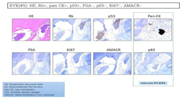 예시로, KYK 환자의 뼈조직에서 각종 면역화학염색을 통해 원발암의 장기를 파악함