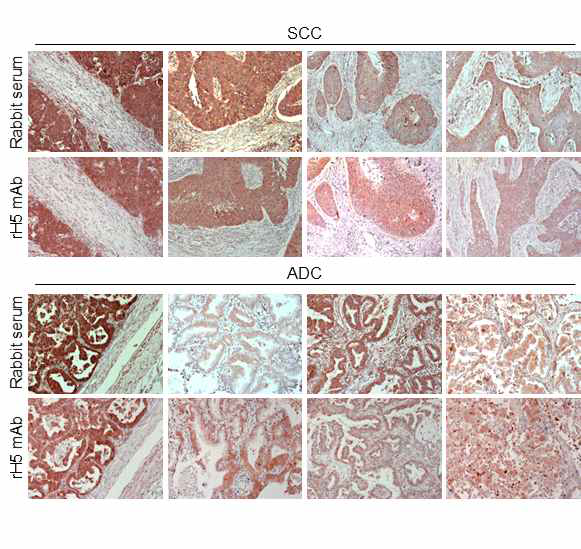 H5 IgG 혹은 polyclonal anti-DX2 rabbit serum을 이용한 폐암조직의 IHC 결과