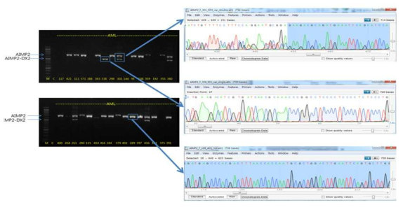 환자 sample에서 AIMP2-DX2의 발현 양상 및 sanger sequencing을 이용한 validation