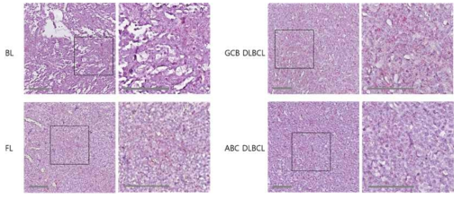 다양한 세부아형별 림포마 조직에서 AIMP2-DX2의 검출