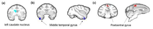Cadate nucleus를 시드로 하였을 때(a), 투여기간에 따라 뇌기능연결성 감소를 보이는 Middle temporal gyrus(b)와 뇌기능연결성 증가를 보이는 Postcentral gyrus(c)