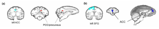 ACC를 시드로 하였을 때, posteria cingulate cortex(PCC)와의 뇌기능 연결성 증가(a), SFG를 시드로 하였을 때, ACC와의 뇌기능 연결성 감소(b)