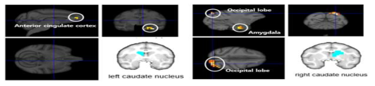 좌우 caudate nucleus를 시드로 하였을 때 투여기간에 따라 뇌기능 연결성 차이를 보인 영역