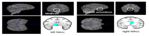 좌우 NAcc를 시드로 하였을 때 투여기간에 따라 뇌기능 연결성 차이를 보인 영역