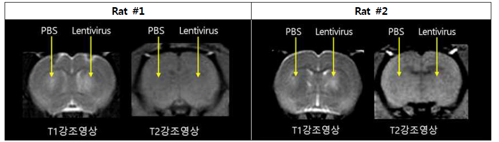 우측 대뇌반구 Putamen에 주입된 Lentivirus의 위치 확인