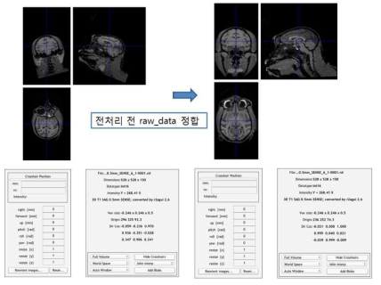 MRI raw data 개체별 정합