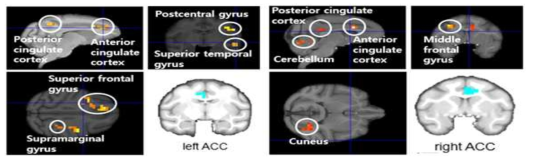 ACC를 시드로 하였을 때, 헤로인 투여기간에 따른 뇌기능 연결성 차이를 보인 영역