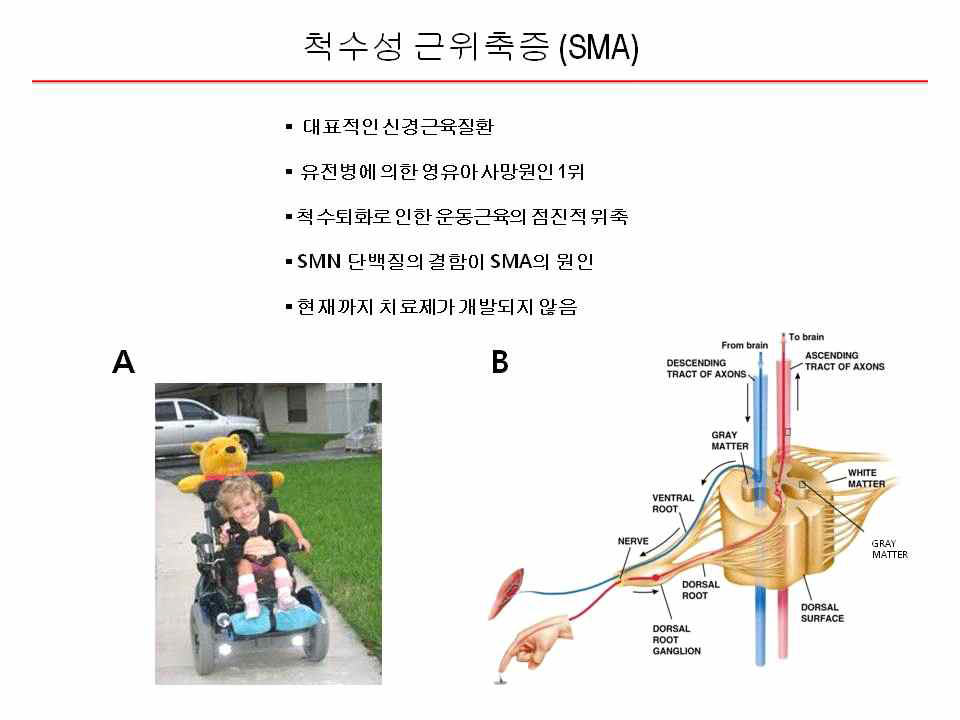 척수성 근위축증은 대표적인 유전성 근육질환 (A) 영유아의 유전병에 의한 사망원1위인 치명적인 질병임. (B) 척수가 퇴화되면서 운동근육이 점차적으로 위축되고 종국에는 사망에 이르게 됨