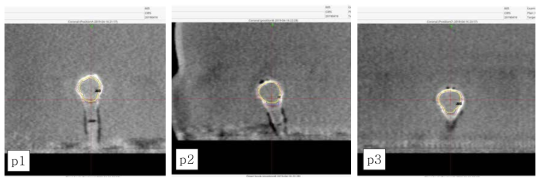 세 가지 다른 위치 (p1, p2, p3)에서 RSVP phantomTM 내 종양 모양 섬광체의 Cone beam computer tomography (CBCT) coronal images. 각각 서로 다른 treatment planning을 수행했고 (파란색 선) 50%의 5Gy isodose의 처방 선량이 주어졌음 (노란색 선)