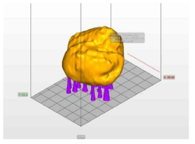 ASIGA Composer 3D 프린팅 소프트웨어를 이용하여 설계된 종양 모형 플라스틱 섬광체 모델링 모습