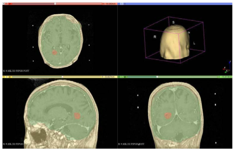 3D Slicer 4.7.0 프로그램을 이용하여 DICOM 이미지 Segmentation을 실시한 모습 (붉은색 : 종양 모델, 초록색 : 조직, 노란색 : 뼈)