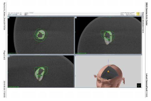 Leksell GammaPlan을 이용하여 청신경 초종에 대한 치료계획을 수행한 모습