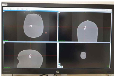 청신경 종양 모형 플라스틱 섬광체에 대한 CT 촬영 Image