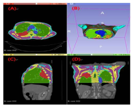 환자 Chest CT 영상을 바탕으로 3D Slicer 프로그램을 사용하여 각 구조물에 대한 Segmentation을 수행한 (A) Axial, (C) Sagittal, (D) Coronal 방향에서의 모습, (B) Image segmentation 후 3D 모델링을 수행한 모습 (빨강-종양, 연두-폐, 파랑-심장, 노랑-뼈, 보라-근육, 하늘-지방, 주황-섬유화 조직, 갈색-피부, 초록-척수)
