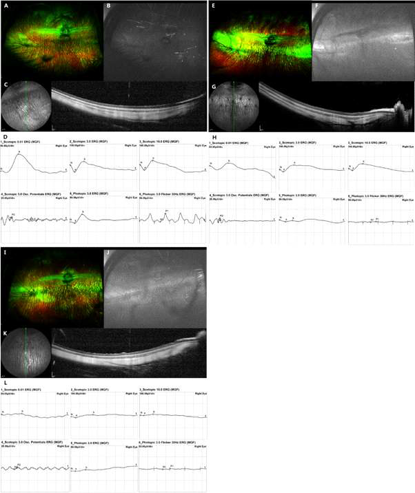 우상 안저 사진, 좌상 자가 형광사진, 좌중 근적외선 사진, 우중 빛 간섭 단층 촬영 OCT, 하단 ERG 검사