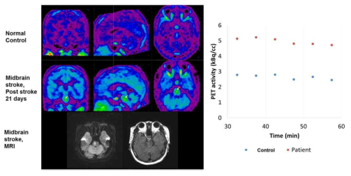 중뇌 뇌경색 환자에서 MRI에서 병변이 있는 부위에 뇌신경염증 PET에서의 섭취가 증가됨을 확인