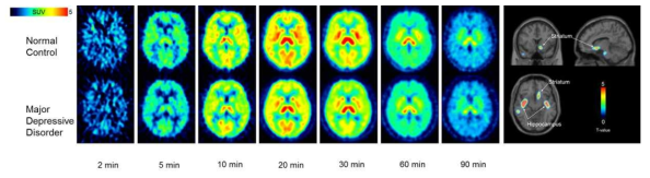 주요우울장애 환자군에서 에서 세로토닌 운반체 표적 영상. Striatum과 hippocampus에서 더 높은 결합능을 보여, 세로토닌성 신경신호전달이 저하되어 있음을 확인