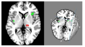 주요 우울장애 환자에서 당대사 감소 (녹색) 및 증가 (붉은색) 부위. BMC psychiatry, 2014)