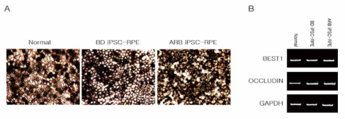 환자유래 역분화 줄기세포로부터 분화된 망막색소상피세포. 세포 특유의 polygonality와 갈색의 pigmentation이 확인 됨 (A). RT-PCR로 망막색소상피세포 marker인 BEST1과 OCCLUDIN의 발현을 확인 함