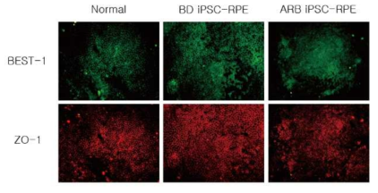 환자유래 역분화 줄기세포로부터 분화된 망막색소상피세포의 Immunocytochemistry. 망막색소상피세포의 tight junction marker인 ZO-1과 BEST1발현을 확인 함