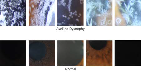 Avellino Dystrophy 질환 진단을 위한 검증용 데이터 세트 영상 샘플