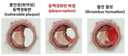 불안정 동맥경화반 (vulnerable plaque)의 파열 경과