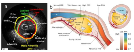 (a) IVUS 분석을 통한 구성정보 획득 (b) 혈류와의 상호작용