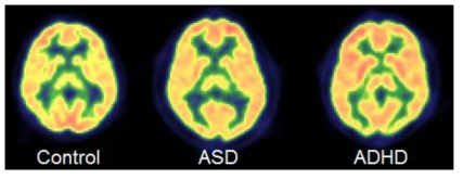 정상발달 및 신경발달장애의 FDG-PET 영상의 예시